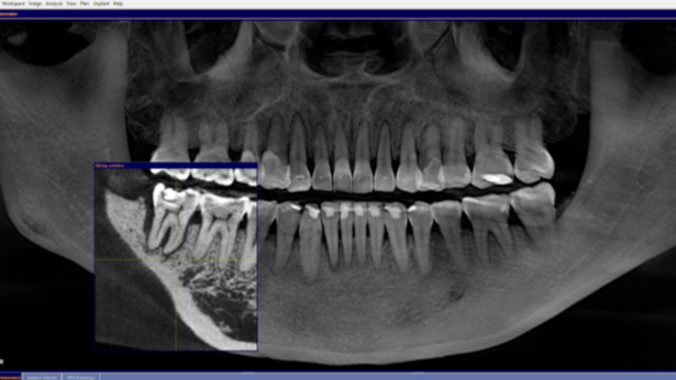 Marcella Zalianty Ungkap Pengalamannya Atasi Gigi Goyang di Devya Dental Clinic, dari Scaling hingga Bone Graft: Ada Metode PRP
            - galeri foto