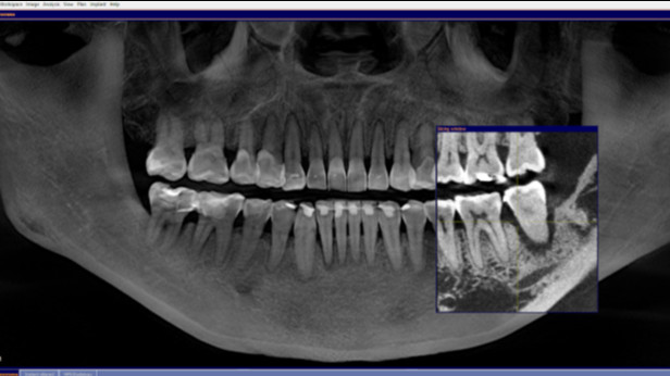 Foto rontgen pasien yang mengalami gigi goyang yang ditangani di Devya Dental Clinic.